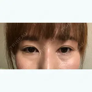 92 days after image