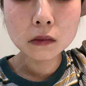 0 days after image