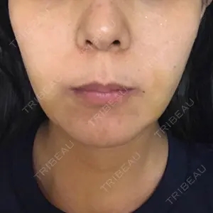 5 days after image