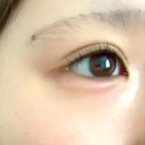 1 days after image