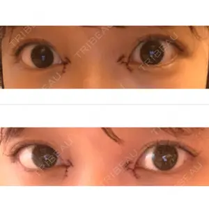 0 days after image