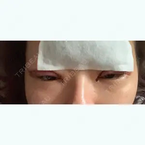 1 days after image