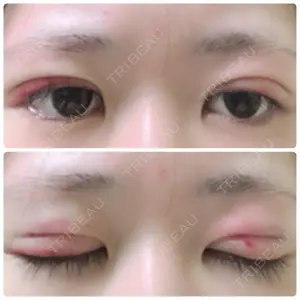 2 days after image