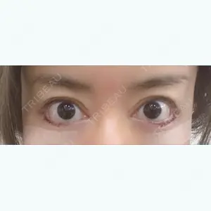 0 days after image