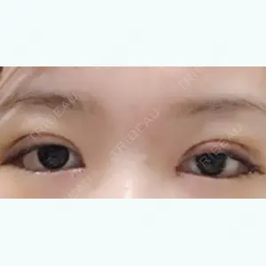 4 days after image