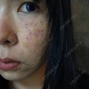 0 days after image