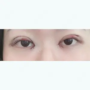 0 days after image