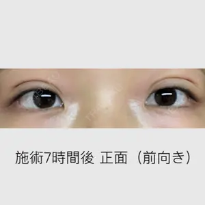 0 days after image