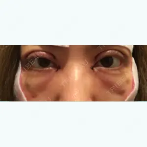 2 days after image