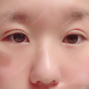 3 days after image