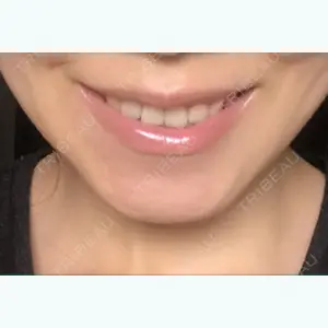 132 days after image