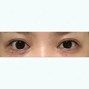 0 days after image