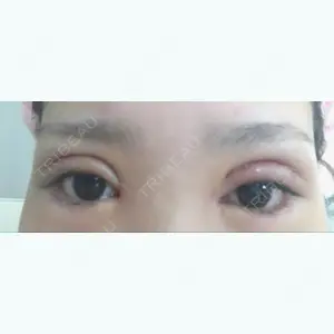 8 days after image