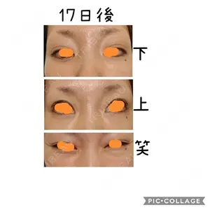 17 days after image