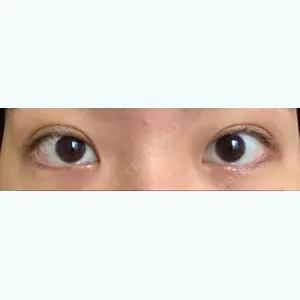 15 days after image