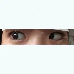 2 days after image
