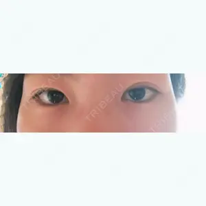 1 days after image