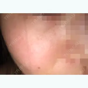 8 days after image