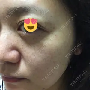 5 days after image
