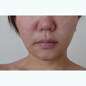 3 days after image