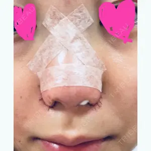 0 days after image
