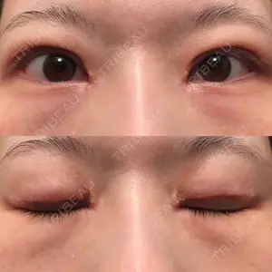 15 days after image
