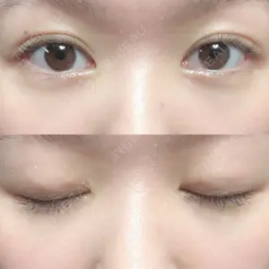 15 days after image