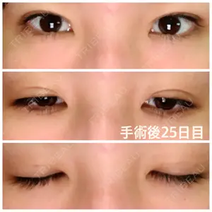 25 days after image