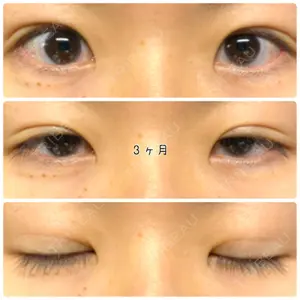 92 days after image