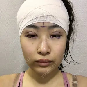 15 days after image