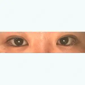 1 days after image