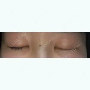 11 days after image