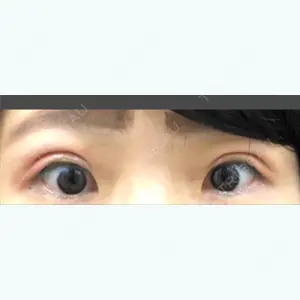 1 days after image