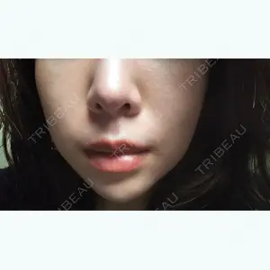 2 days after image