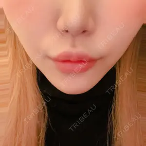 10 days after image