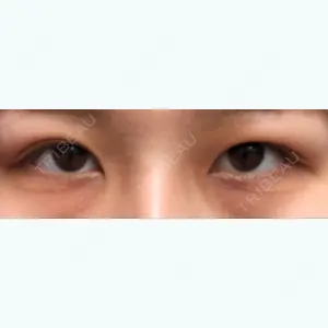 0 days after image