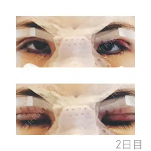 2 days after image