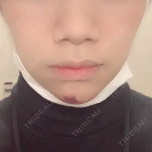 1 days after image