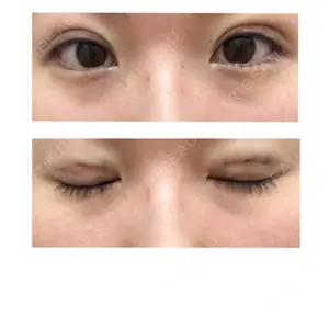 0 days after image