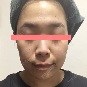 5 days after image