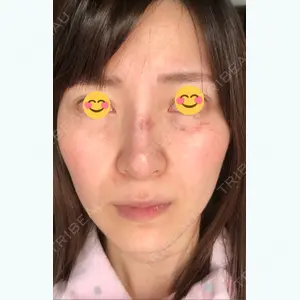 3 days after image