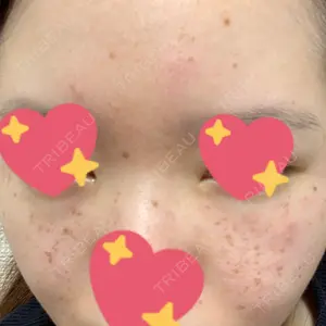 1 days after image