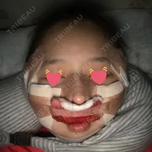1 days after image