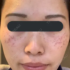 1 days after image
