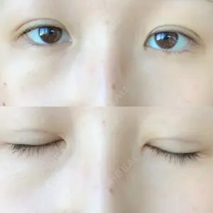 2 days after image