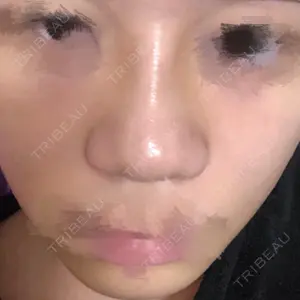 5 days after image
