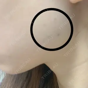 1 days after image
