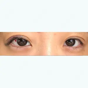 1 days after image