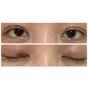 4 days after image