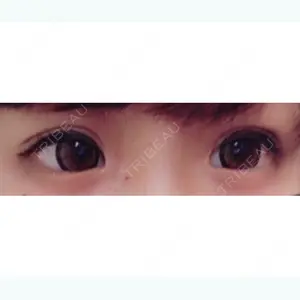 2 days after image